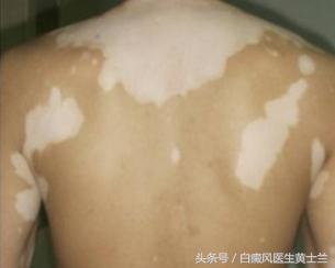 喝茶可以淡化黄褐斑吗,喝茶能治疗白癜风吗