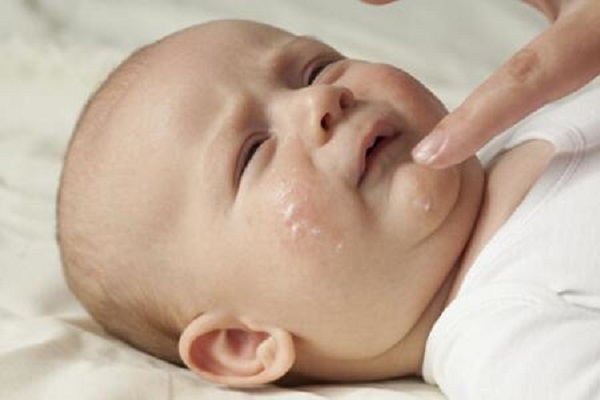 宝宝哭闹脸上起湿疹怎么回事,婴儿脖子有湿疹会一碰就哭闹