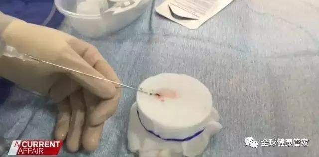 澳洲治疗中风可怕副作用,澳洲十大黑科技药