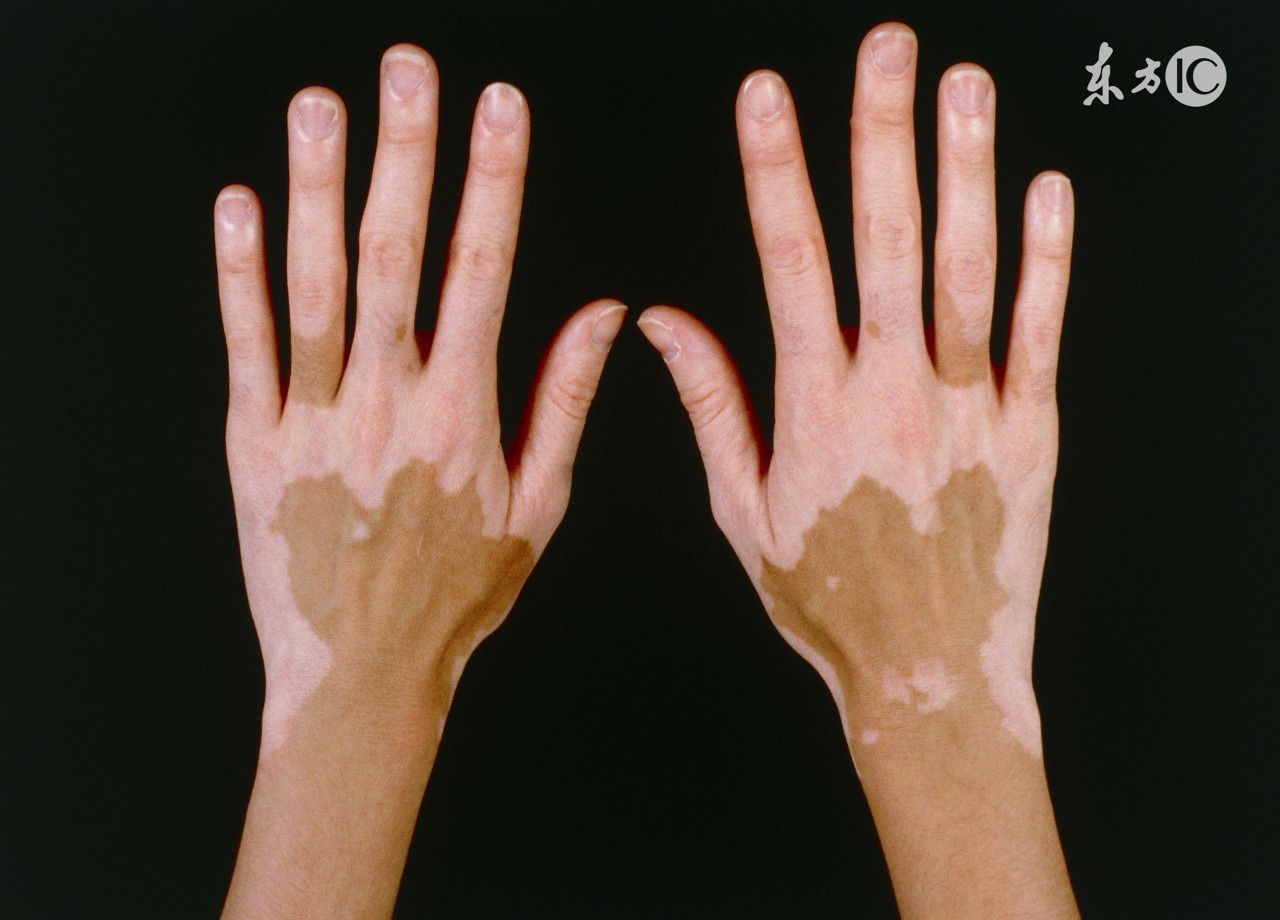 白癜风四个月才发现晚吗,嘴下面刚发现白癜风好治吗