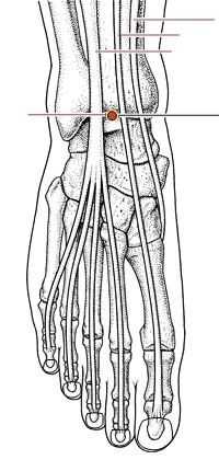 心烦失眠针灸,心烦针灸哪个穴位