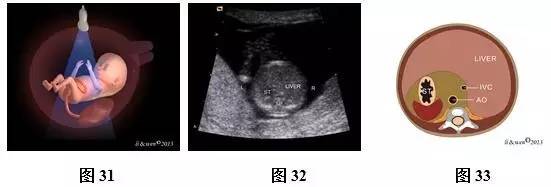 孕26周进行胎儿超声心动图检查,孕11-14周胎儿超声检测报告