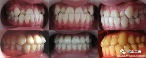 「医生说」“地包天”不容忽视口腔正畸专家提醒，越早接受治疗效果越好