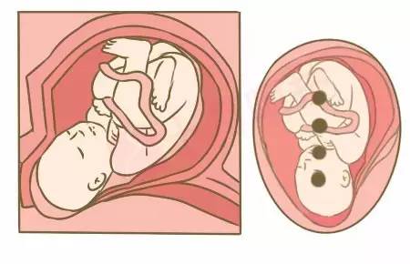 二孩时代，小心剖宫产瘢痕妊娠