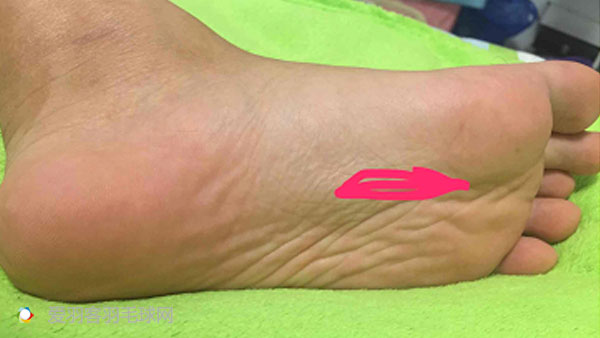 脚疼的15种原因和治疗方法,脚疼怎么才能彻底根治