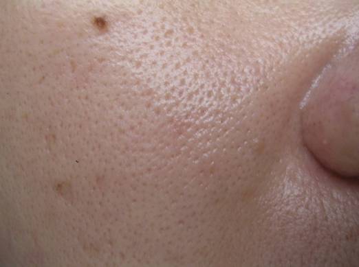 十年战痘血泪史详解,战痘知识分享