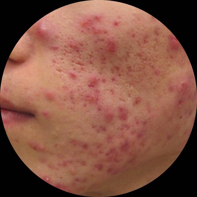 战痘大结局完整版,战痘合集完整版