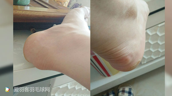 脚疼的15种原因和治疗方法,脚疼怎么才能彻底根治