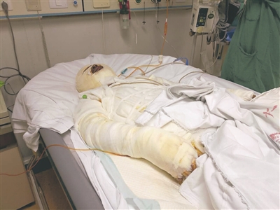 南通中远船厂电焊工烧伤仍未脱离危险巨额医疗费难倒一家人