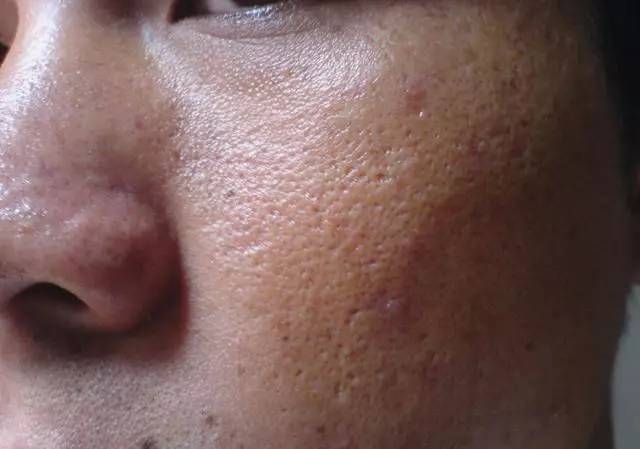 战痘合集完整版,战痘大结局完整版