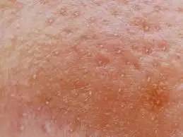 战痘大结局完整版,战痘合集完整版