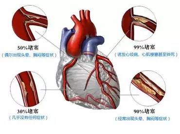 冠心病我们怎样才能预防心得体会,冠心病新指南变化内容