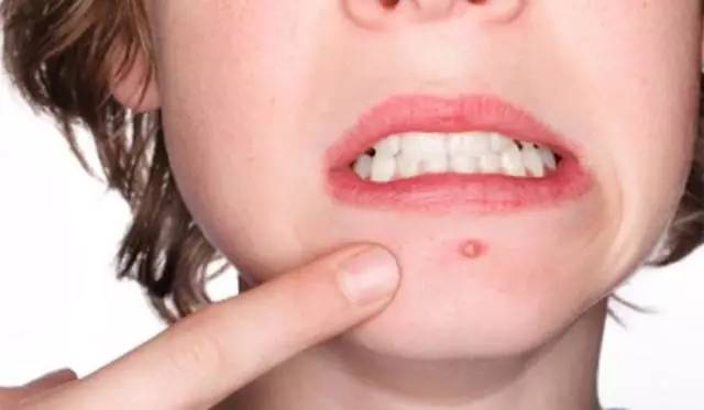 战痘合集完整版,战痘大结局完整版