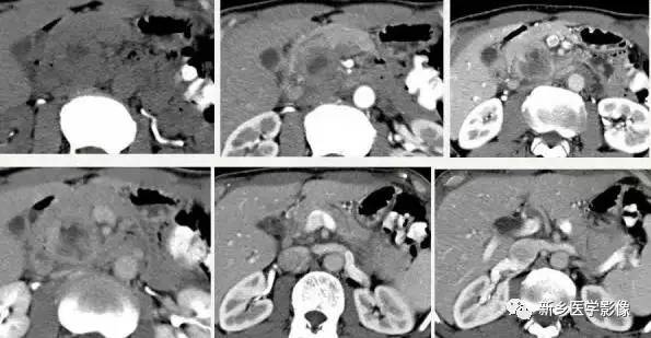 18种疾病包括哪些,18种肿瘤有哪些