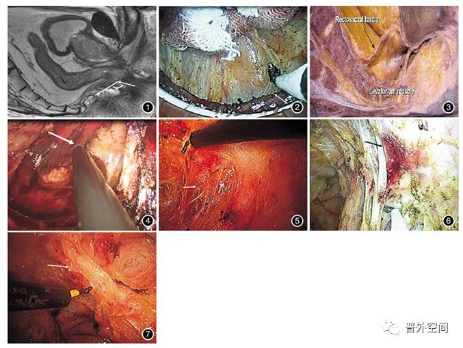 经肛直肠癌切除术指征有哪些,低位直肠癌保肛手术常见的并发症
