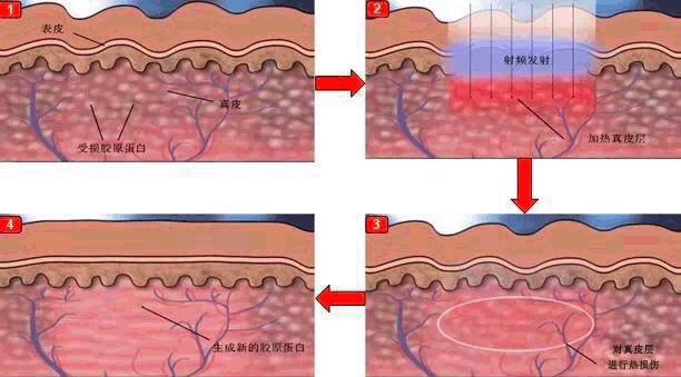 射频美容仪干货,讲干货属于噱头吗