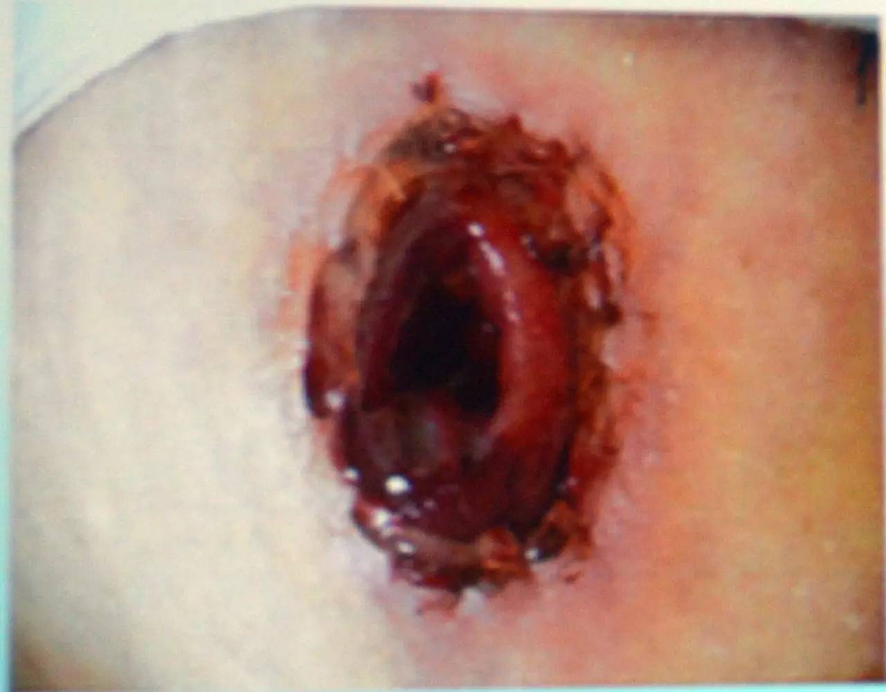 肠造口回纳的并发症是什么,膀胱全切肠造口有什么并发症