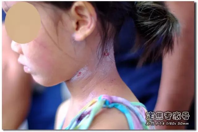 「热点」越是古老的疾病坑越多,一个湿疹能有多少坑把父母掉进去?