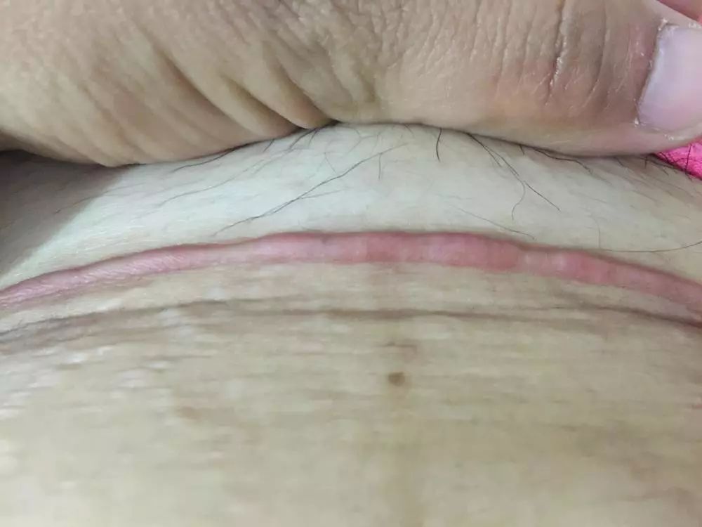 产后刀口增生的原因和治疗方法,产后侧切刀口痒是怎么回事