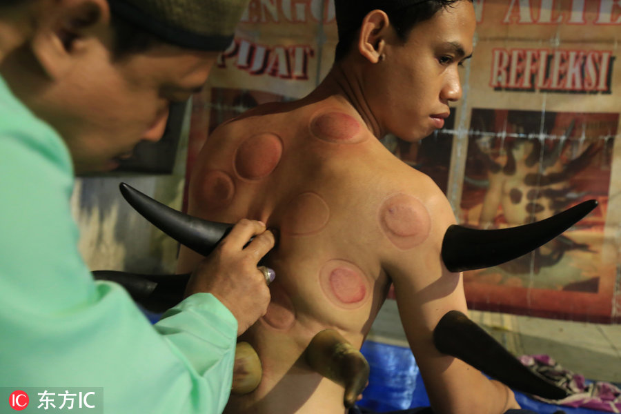 印尼治腰腿疼的药,大连牛角拔火罐疗法