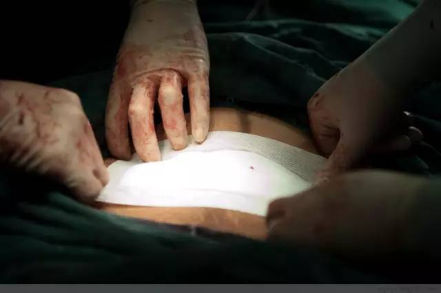 剖腹产全景记录,剖腹产恢复不同时期的照片