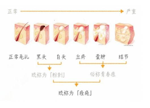战痘多年如何重回颜值巅峰,战痘逆袭之路
