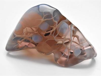 粒子植入治疗肿瘤原理,3d打印肿瘤模型使癌症患者康复