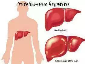 自身免疫性肝病产生原因,自身免疫系统肝病早期什么症状
