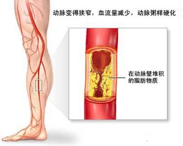 老人腿疼是血管原因的话怎么治疗,疏通血管软化血管最好的食物