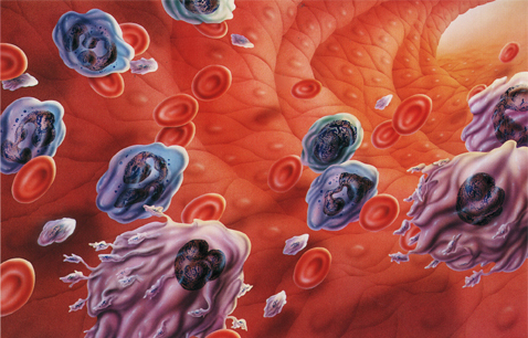 医学科普：什么是皮肤白血病？