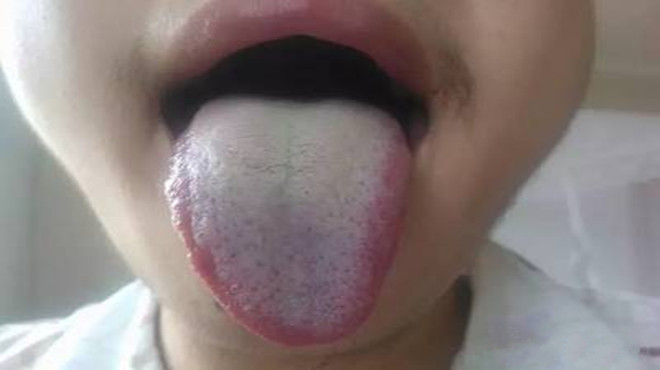 舌头有什么病检查什么,舌头有问题是怎么回事