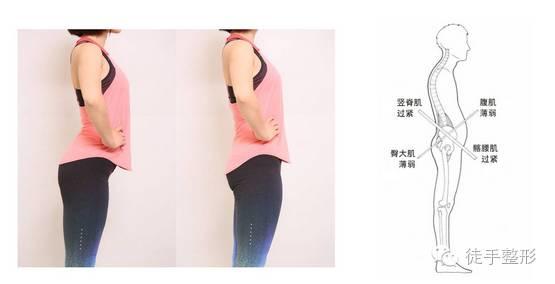 盆骨整形调整视频,郝强骨盆前倾矫正