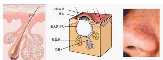 神器握在手草莓鼻远走木薯吸黑头仪评测