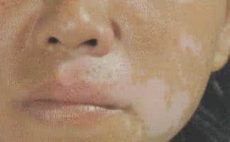 自己的孩子身患白癜风,多次治疗无果!一怒之下联合多位白癜风专家研究出新型治疗方法,从黑色素下手