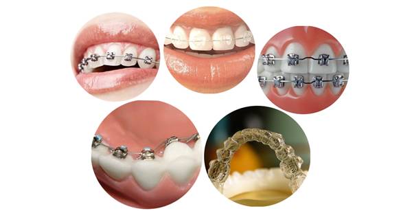 戴牙套为什么会矫正,牙套贵的和便宜的区别