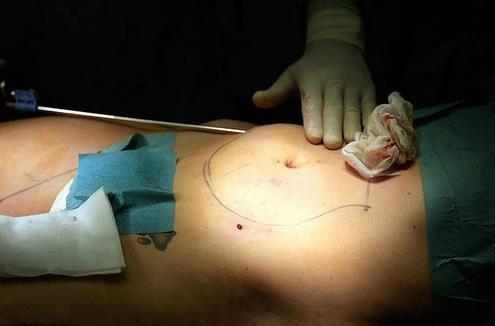 微创介入动脉瘤栓塞手术,脑部介入栓塞手术安全系数高吗