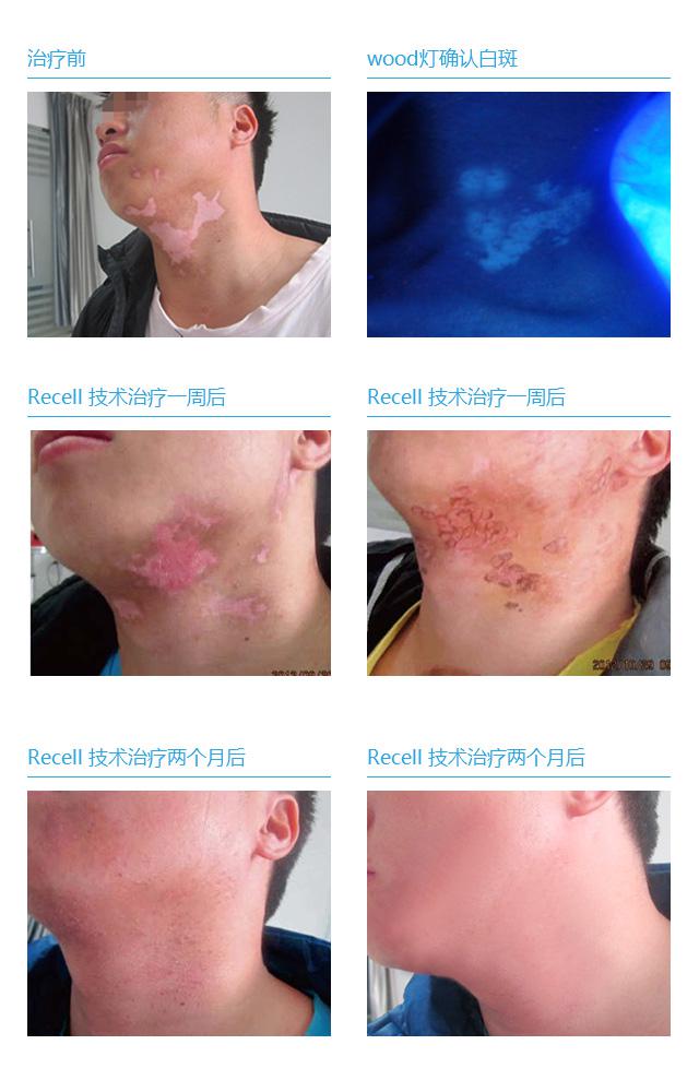 国际目前最有效的治疗白癜风,中国治疗白癜风顶级专家