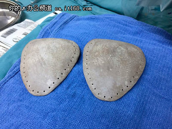 3d打印肿瘤最佳方法,3d打印技术在医学方面成功案例