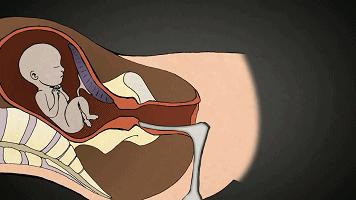 4个月引产无痛好还是普通引产好,五个月引产做无痛引产真的不痛吗