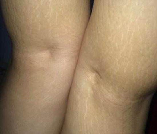 肥胖肚皮长花纹怎么办,肚子上有纹路胖子瘦下来能消除吗