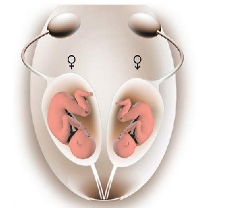 那么多年不孕？会不会是双子宫在作怪？