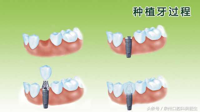 保留坏牙的几种方法,坏牙是不是越早拔越好