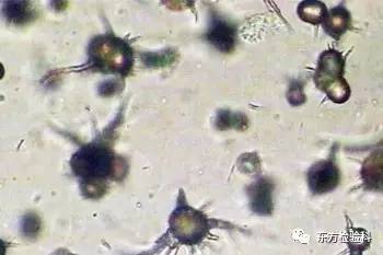 尿中结晶达到多少就是结石了,尿结晶数高是病吗