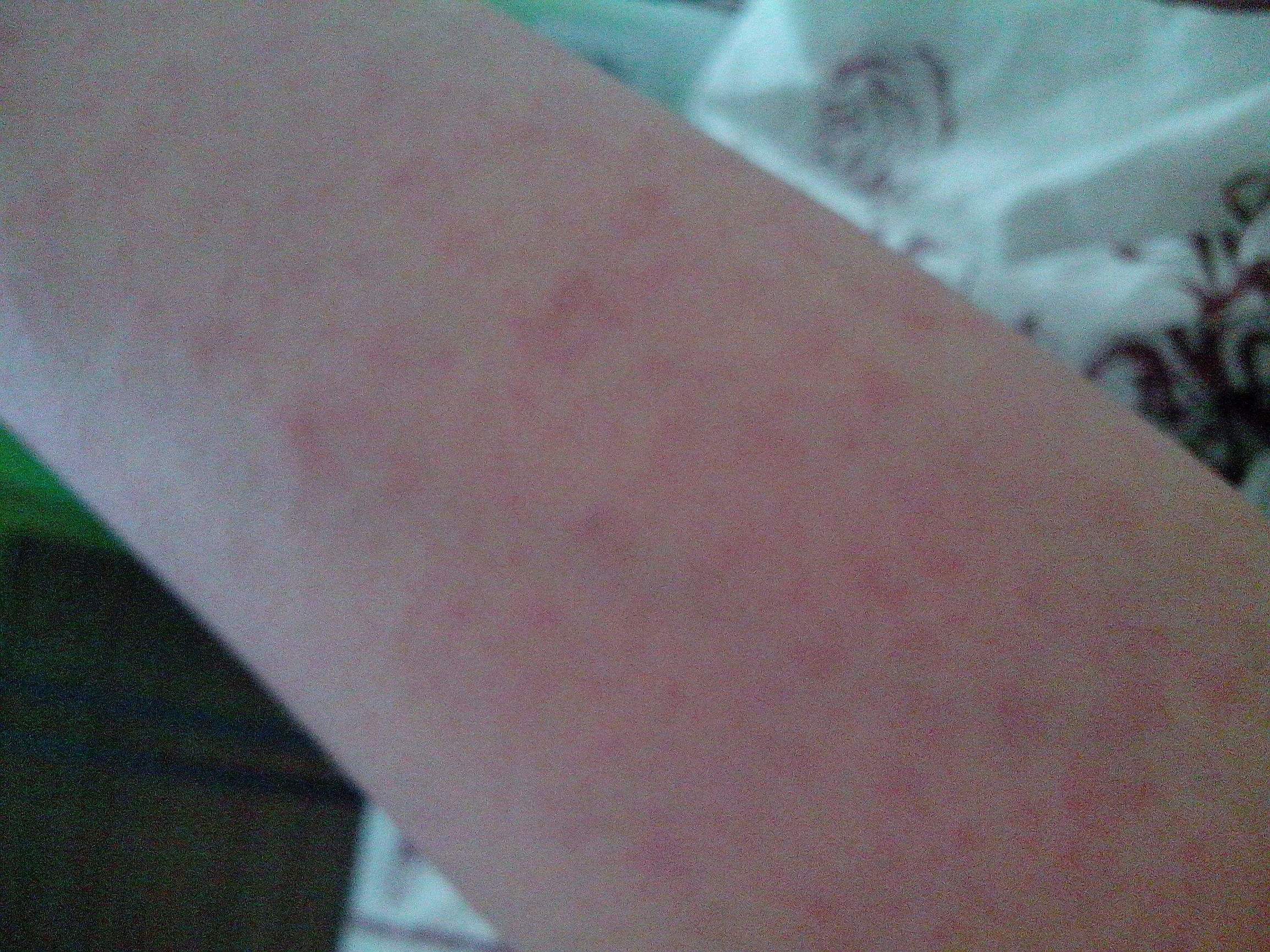 身上长小红点不痛不痒变成黑点,身上长红点像红色小痣怎么回事