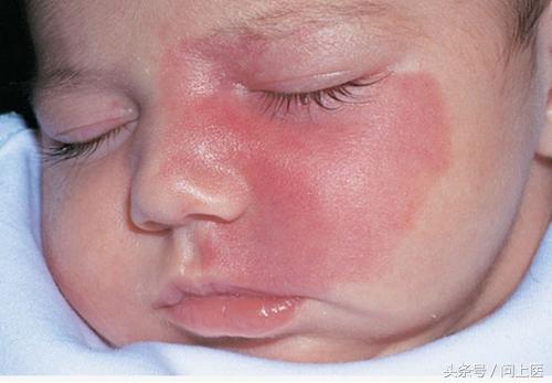 你有胎记吗？图解8种常见胎记