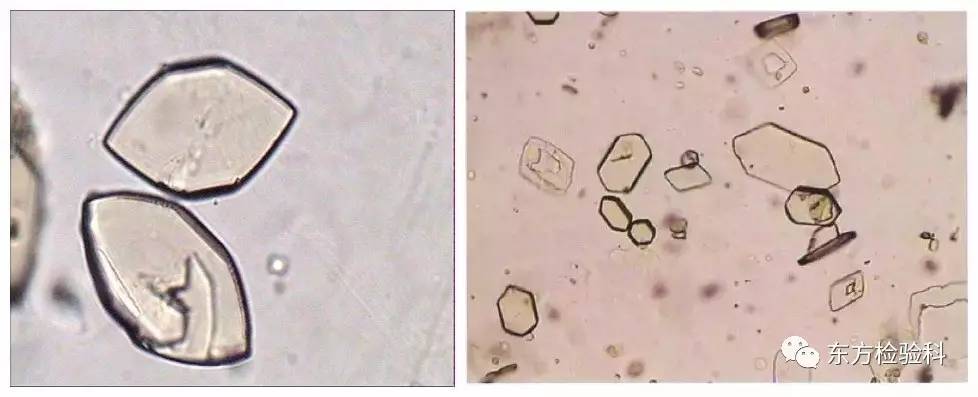 尿中结晶达到多少就是结石了,尿结晶数高是病吗