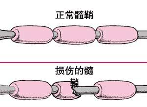 北京中医脱髓鞘,西安治疗脱髓鞘最好中医