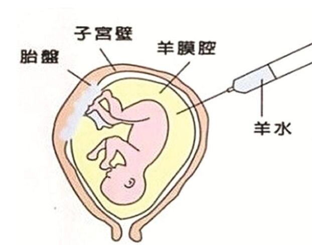 羊水穿刺针头扎到胎儿会怎么样,羊水穿刺会扎到大脑吗