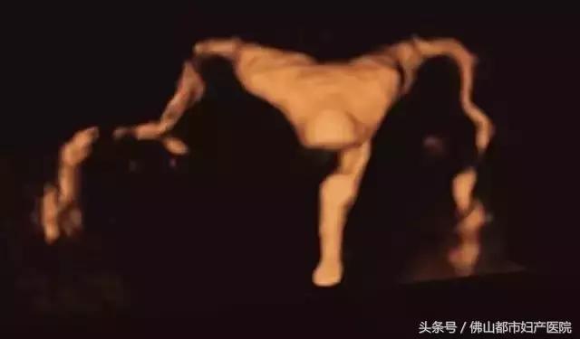 输卵管四维超声造影，不孕患者的福音