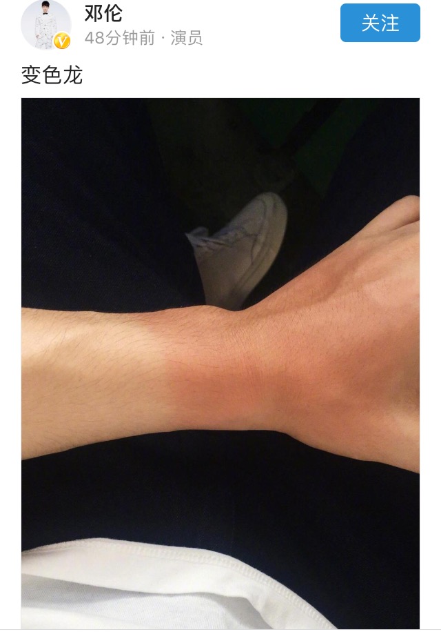 邓伦晒伤胳膊，网友重点跑偏：手毛有点多